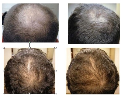 Lepotni studio Dreams - Pospeševanje rasti las