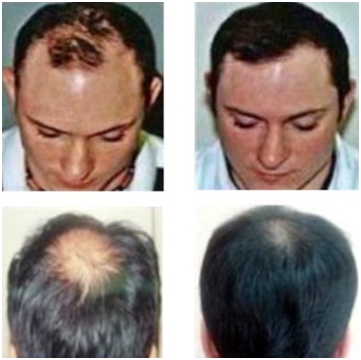 Lepotni studio Dreams - Pospeševanje rasti las